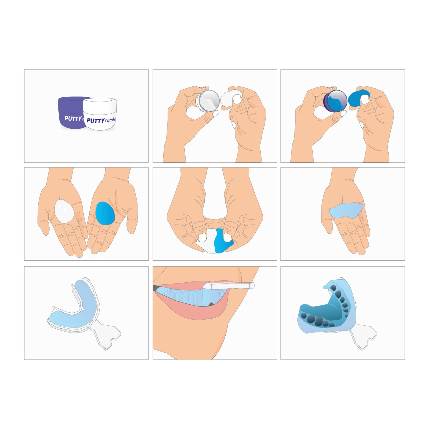 E&E VPS Putty + Tray Kit – 5 Sets of 30ml (45g) Base & Catalyst + 6 Upper & Lower Impression Trays (Large, Medium, Small)